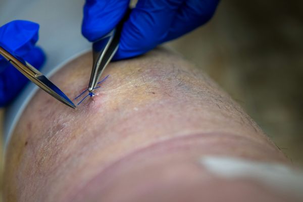 Top 5 traitements efficaces pour réduire les cicatrices chéloïdes